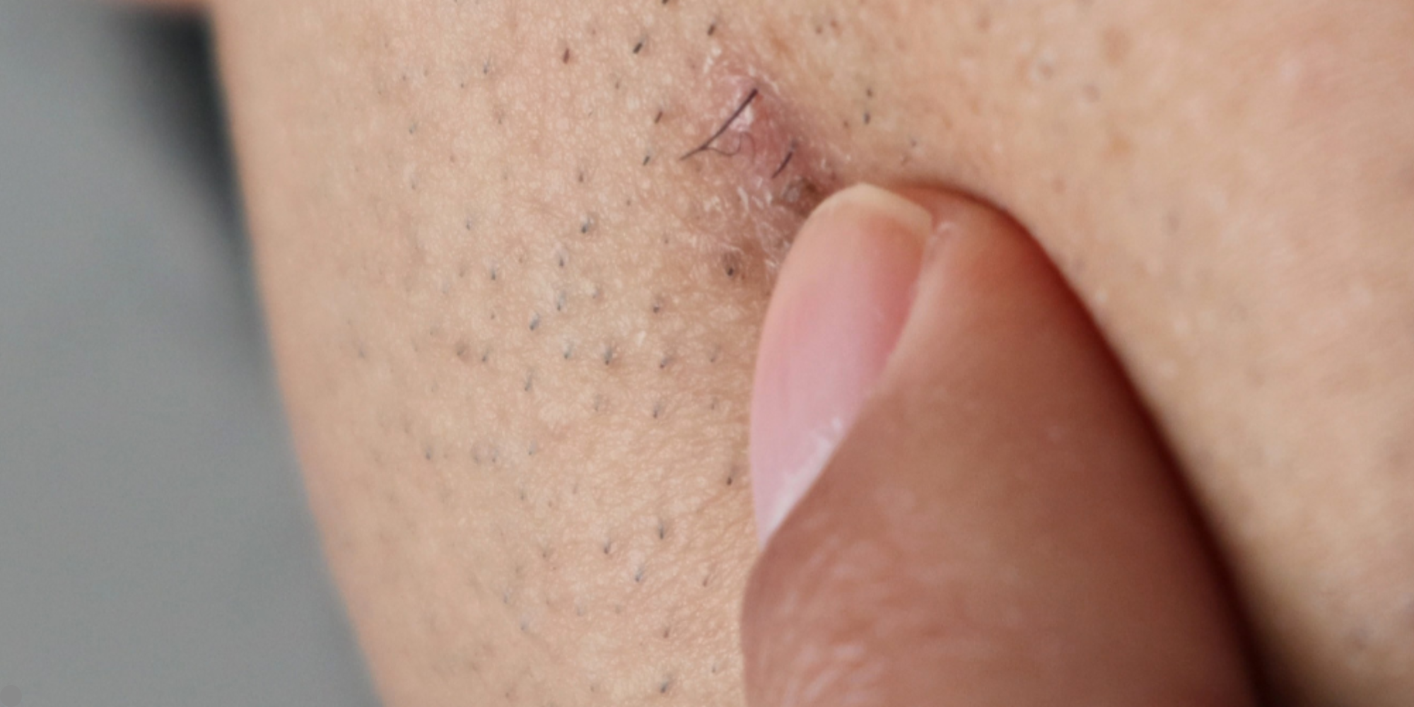 Depilación Definitiva Vello Enterrado En Axila Laser Vellos